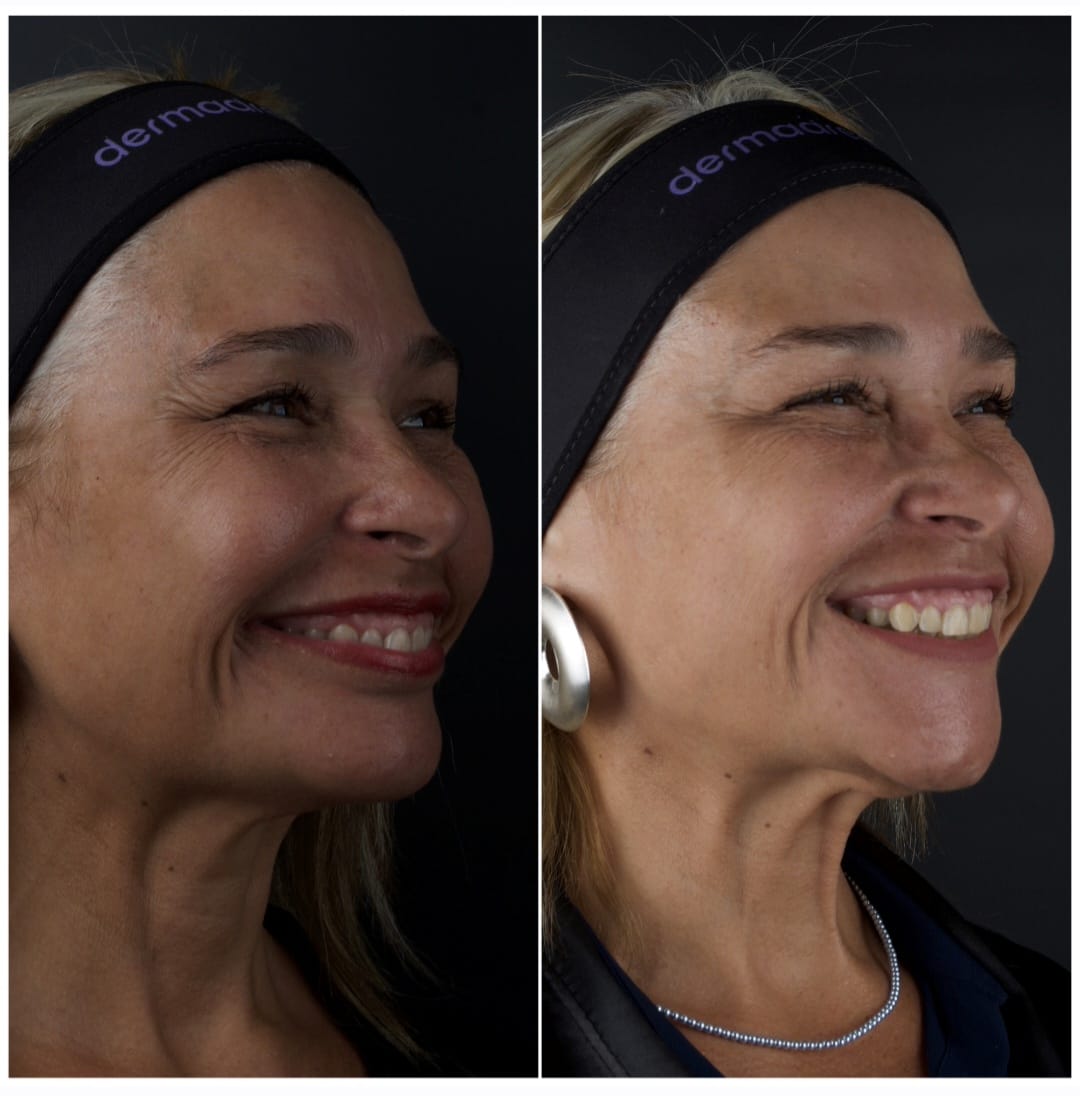 Resultado antes e depois de tratamento full face 4