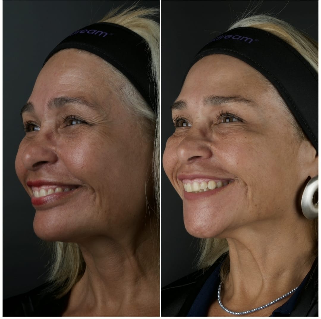 Resultado antes e depois de tratamento full face 5