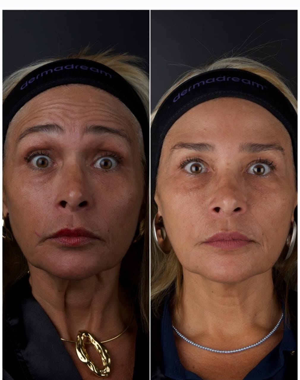 Resultado antes e depois de tratamento full face 1