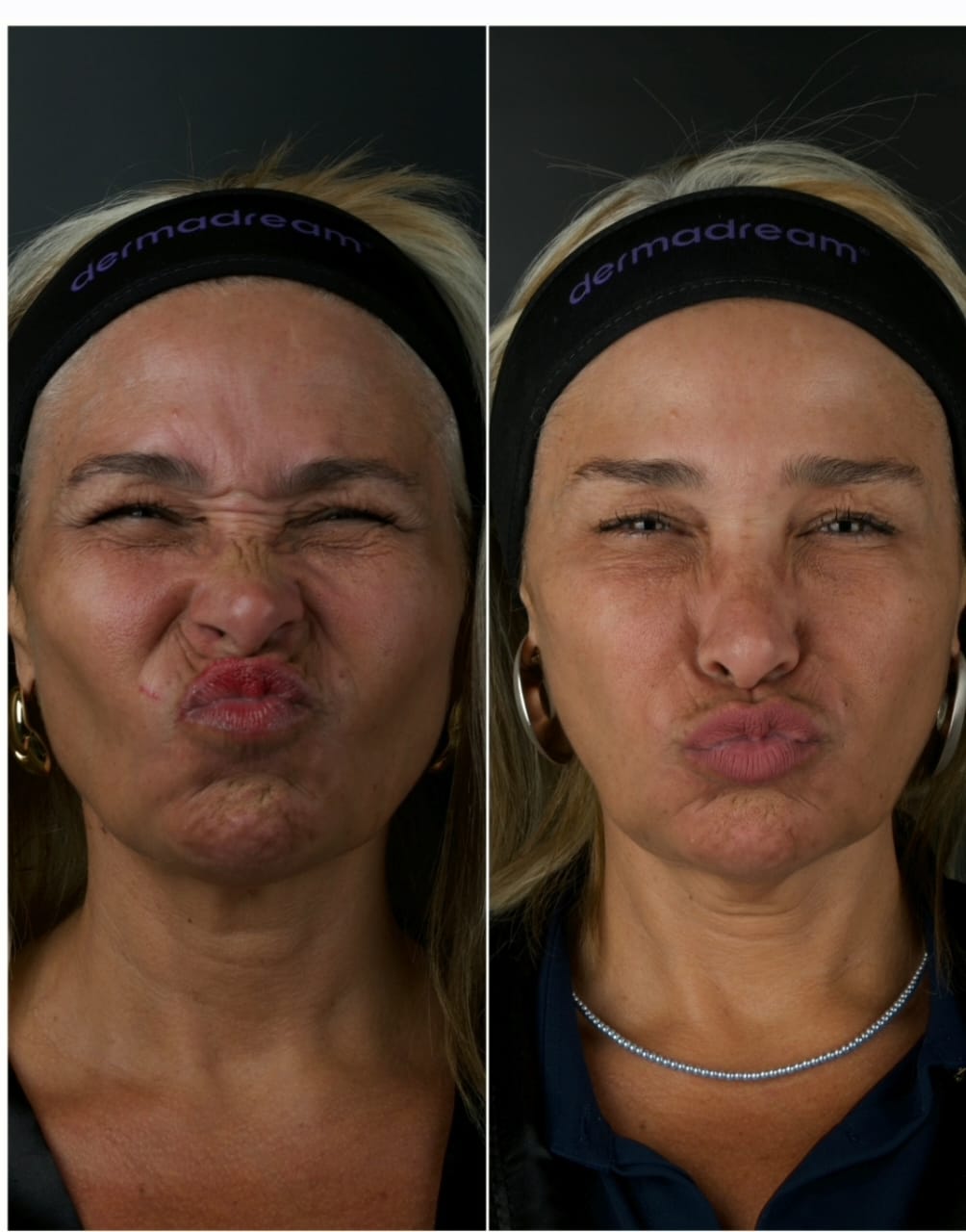 Resultado antes e depois de tratamento full face 3