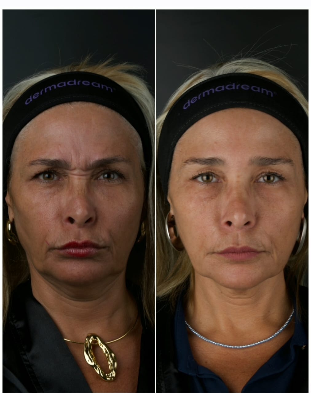 Resultado antes e depois de tratamento full face 2